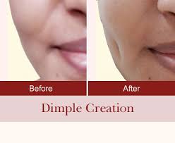 DIMPLE CREATION SURGERY